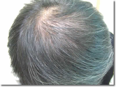 「頭髪実験」2007年2月-1