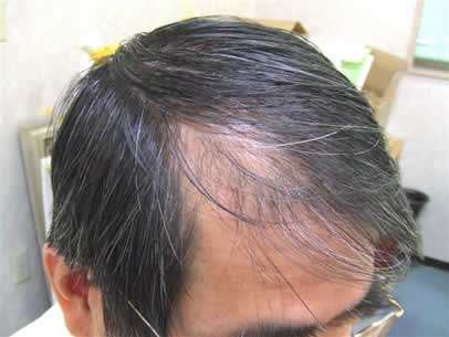 「頭髪実験」2008年3月-1