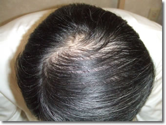 「頭髪実験」2006年2月-2