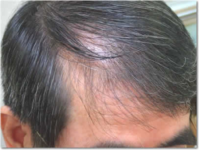 「頭髪実験」2007年7月-1