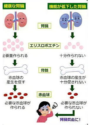 腎臓貧血　イラスト