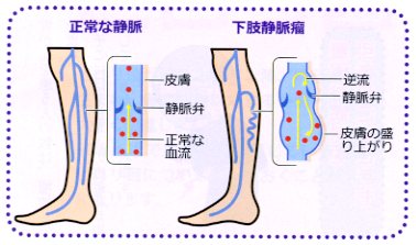 下肢静脈瘤
