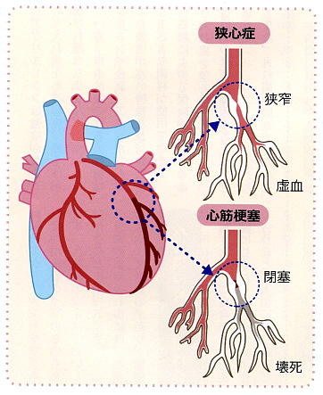 狭心症