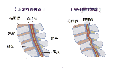 腰部脊柱管狭窄症イラスト
