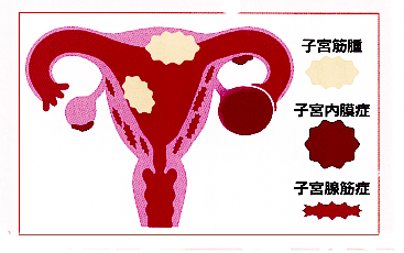 女性の3大良性疾患　イラスト