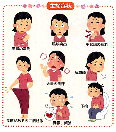 バセドウ病 イラスト