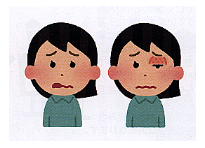 クインケ浮腫　イラスト