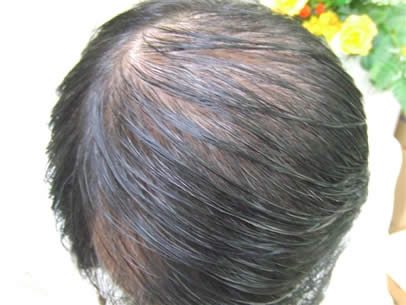 「頭髪実験」2008年3月-2