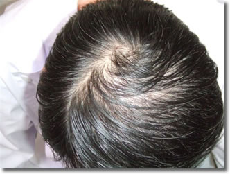「頭髪実験」2006年1月-2