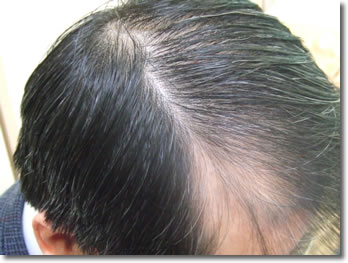 「頭髪実験」2006年3月-1