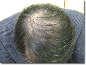 「頭髪実験」2006年3月-2