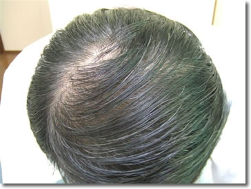 「頭髪実験」2006年5月-2