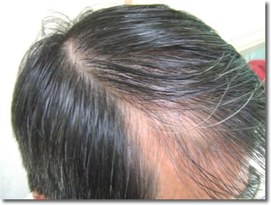 「頭髪実験」2006年8月-2