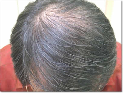 「頭髪実験」2007年7月-2